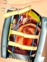 Open Heart Surgery Simulator Screen Shot 9