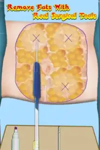 Liposuction Surgery Game Screen Shot 2