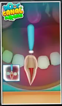 Root Canal Surgery Screen Shot 2