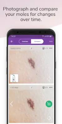 Miiskin - Skin Cancer eHealth. Track & Check Moles Screen Shot 1