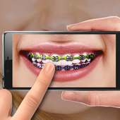 Braces on Photo. Editor